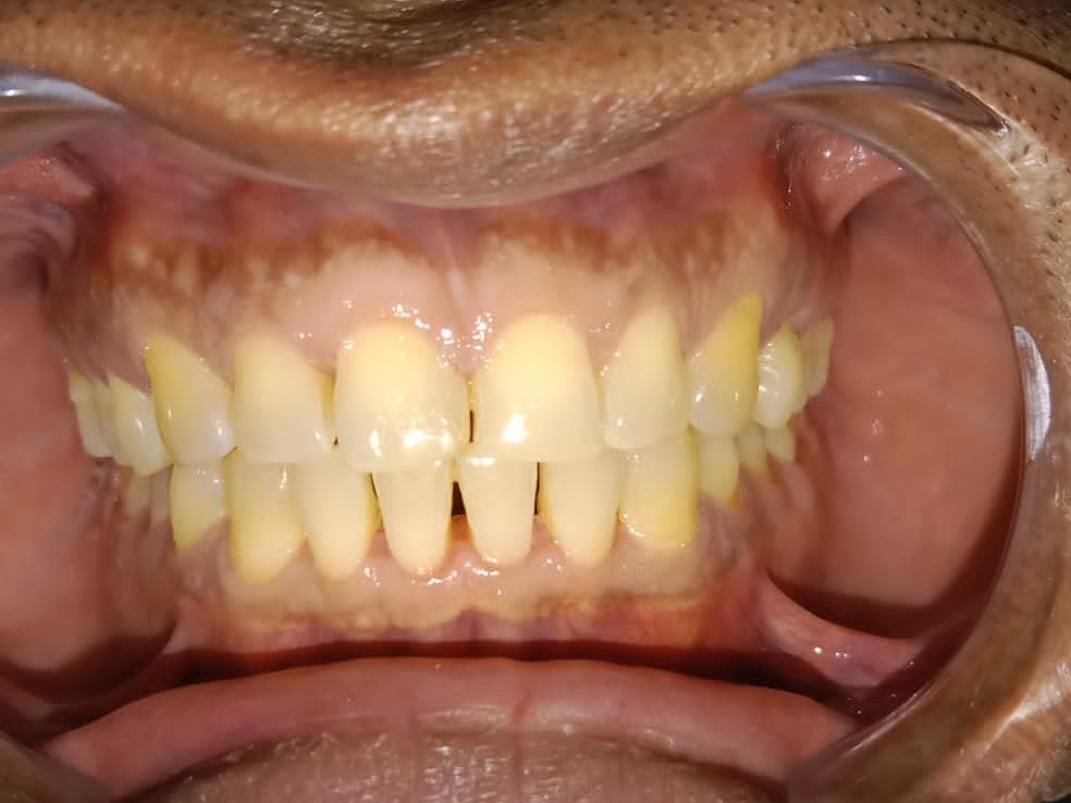 Before — full mouth retracted view at consultation showing post-ortho relapse, crowding and shade before Invisalign Lite