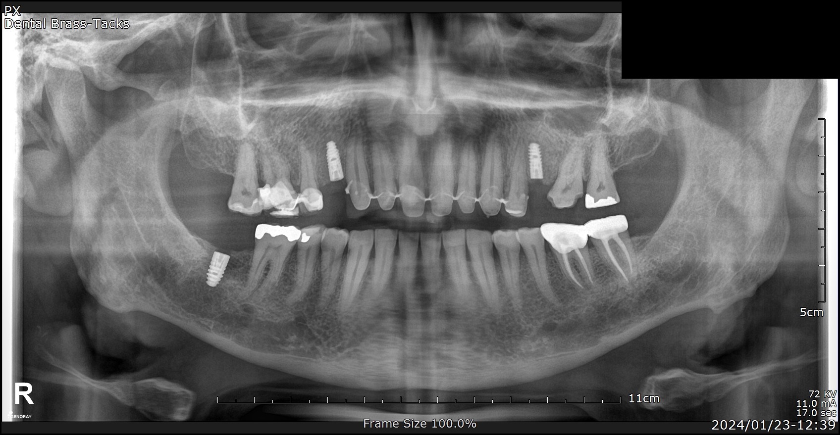 Post-surgery OPG panoramic X-ray showing three Ankylos Dentsply Sirona implants in place