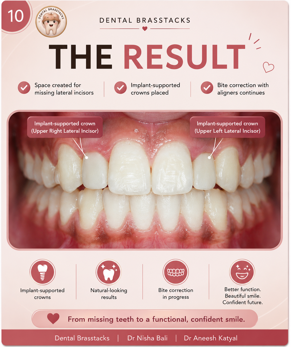 Final result showing implant-supported crowns replacing both upper lateral incisors