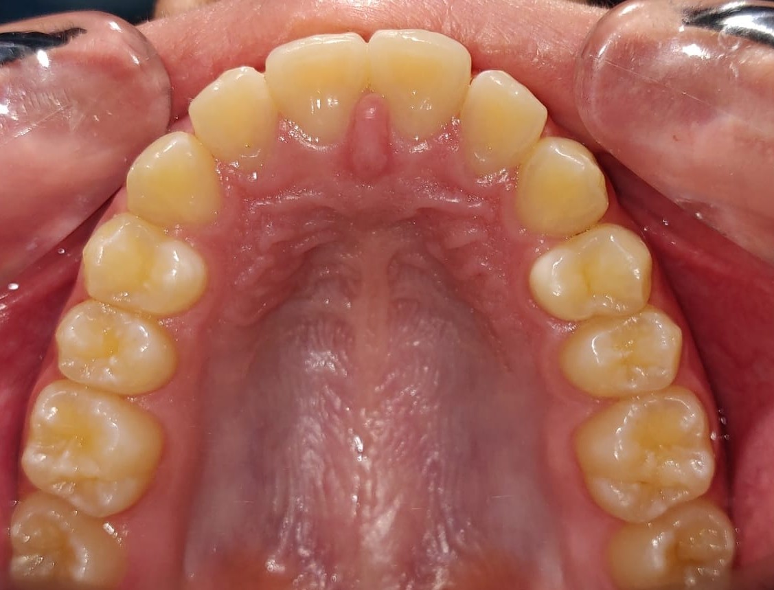 Upper arch occlusal view after Invisalign Lite — aligned arch form, no rotations, whitened shade