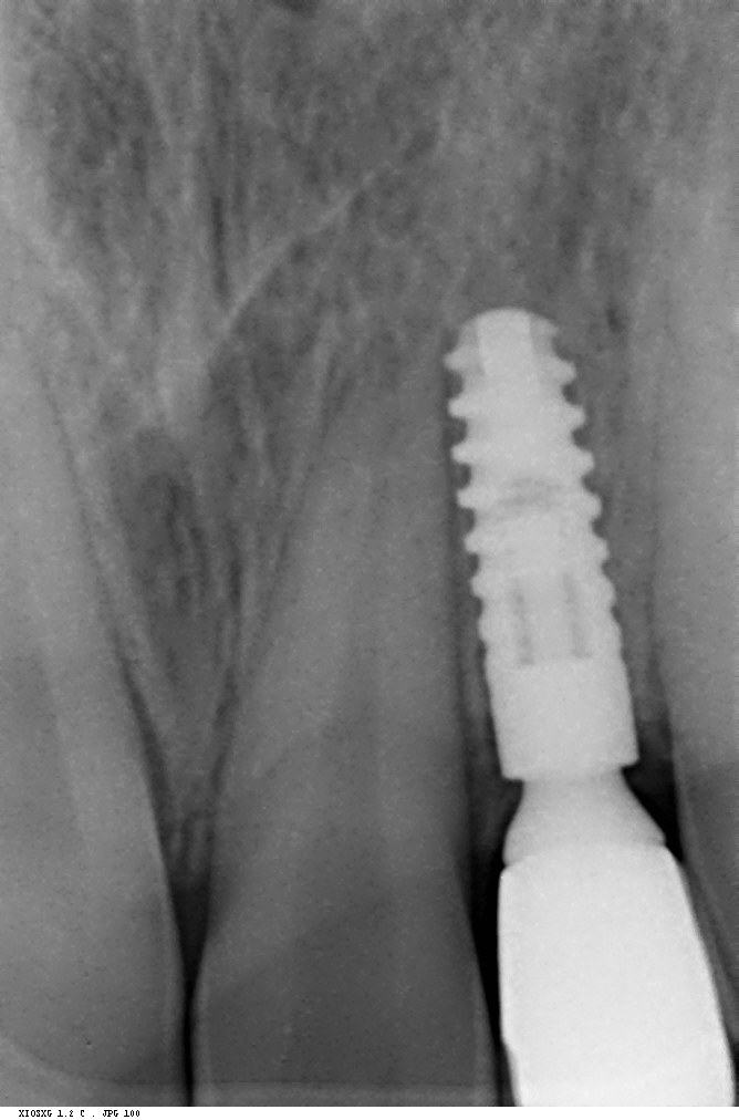Periapical X-ray of the second completed upper implant in the lateral incisor region