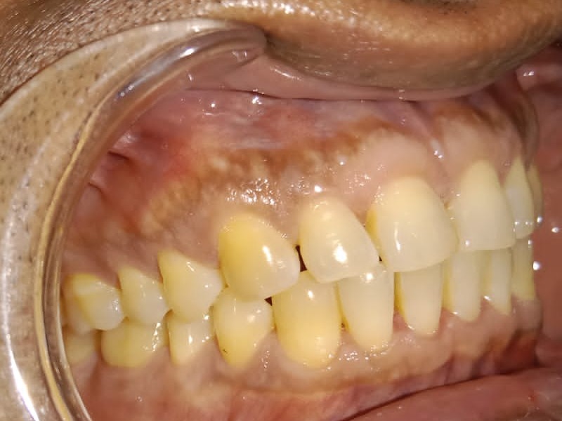 Before — close-up showing rotated lateral incisor and post-relapse crowding