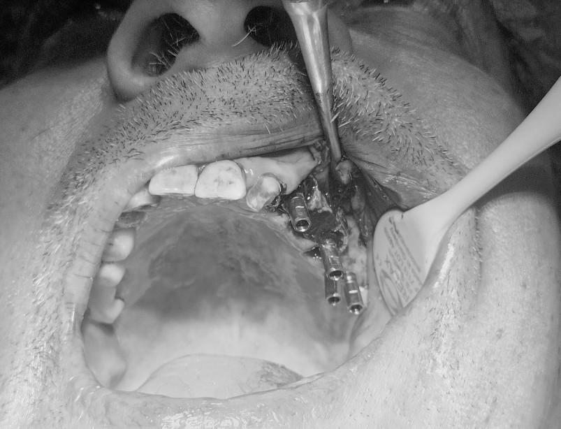 Intraoral view: 4 dental implants placed in the upper left maxilla after direct sinus lift surgery