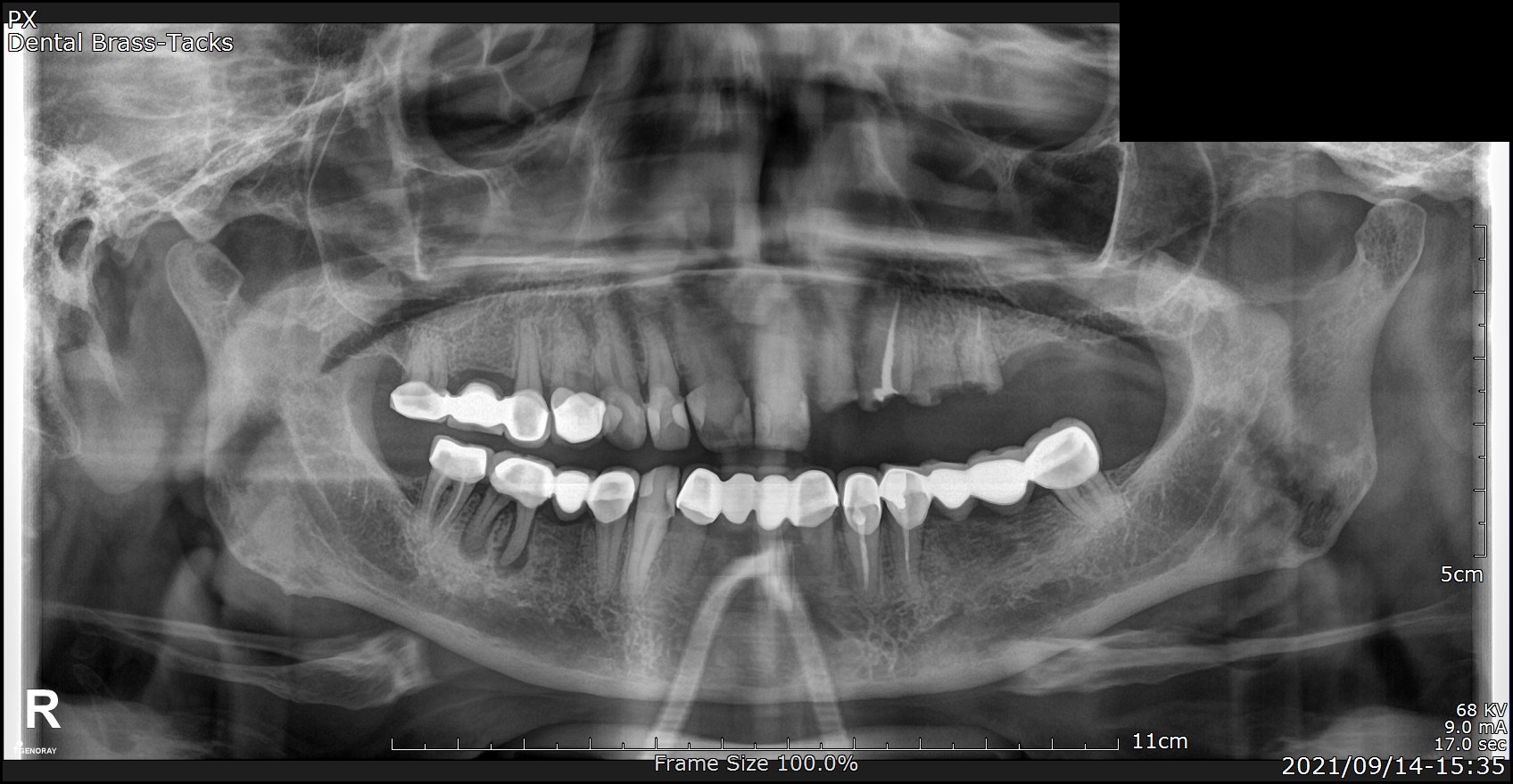 Before — 2021 — panoramic dental X-ray showing implant rehabilitation at Dental Brasstacks, Gurgaon