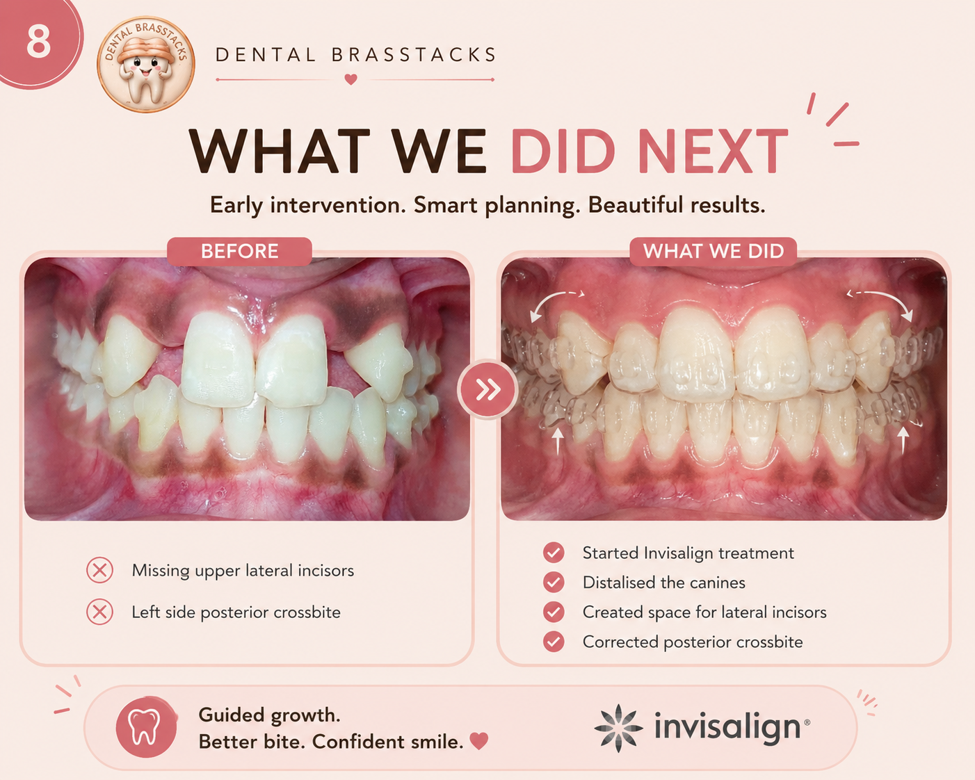 Educational treatment summary showing the staged Invisalign approach used in this case