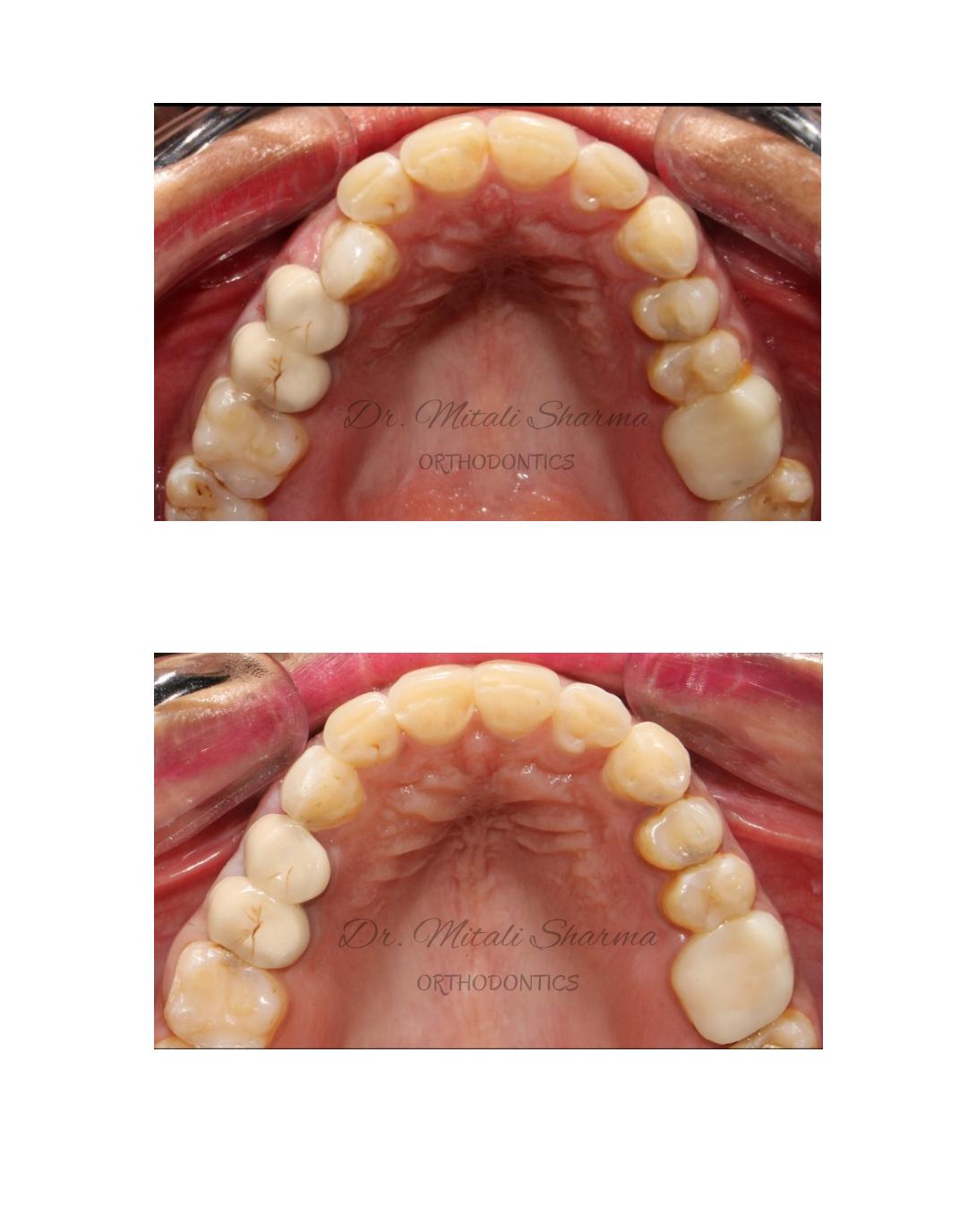Upper arch occlusal view before and after Invisalign Lite — expanded, symmetrical arch form