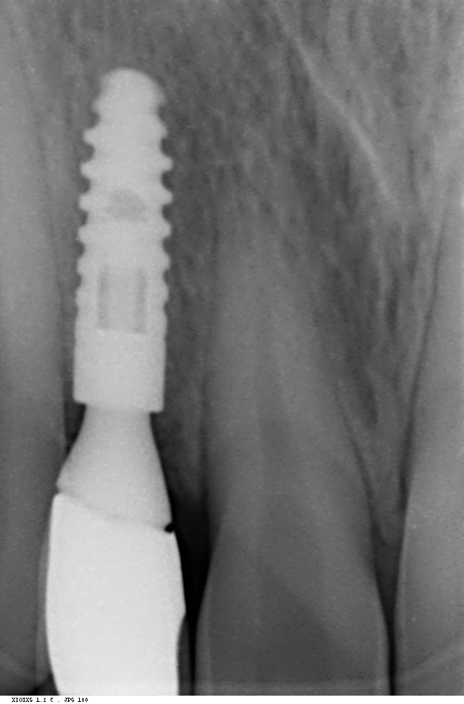 Periapical X-ray of a completed upper implant in the lateral incisor region