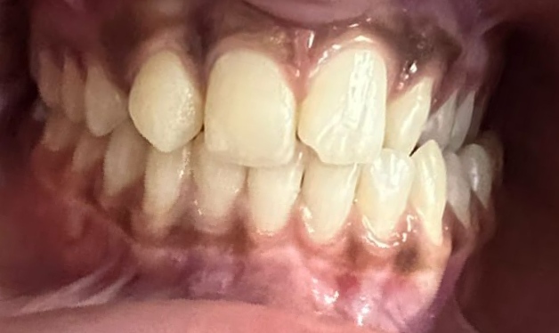 Lower occlusal dental photograph showing crowding before treatment