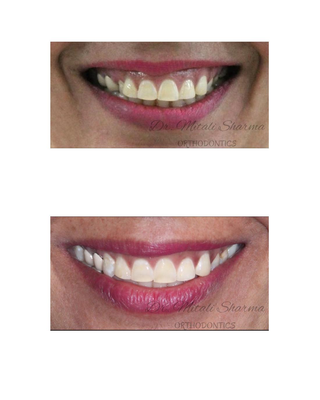 Smile before and after Invisalign Lite — canine crossbite and Class II corrected
