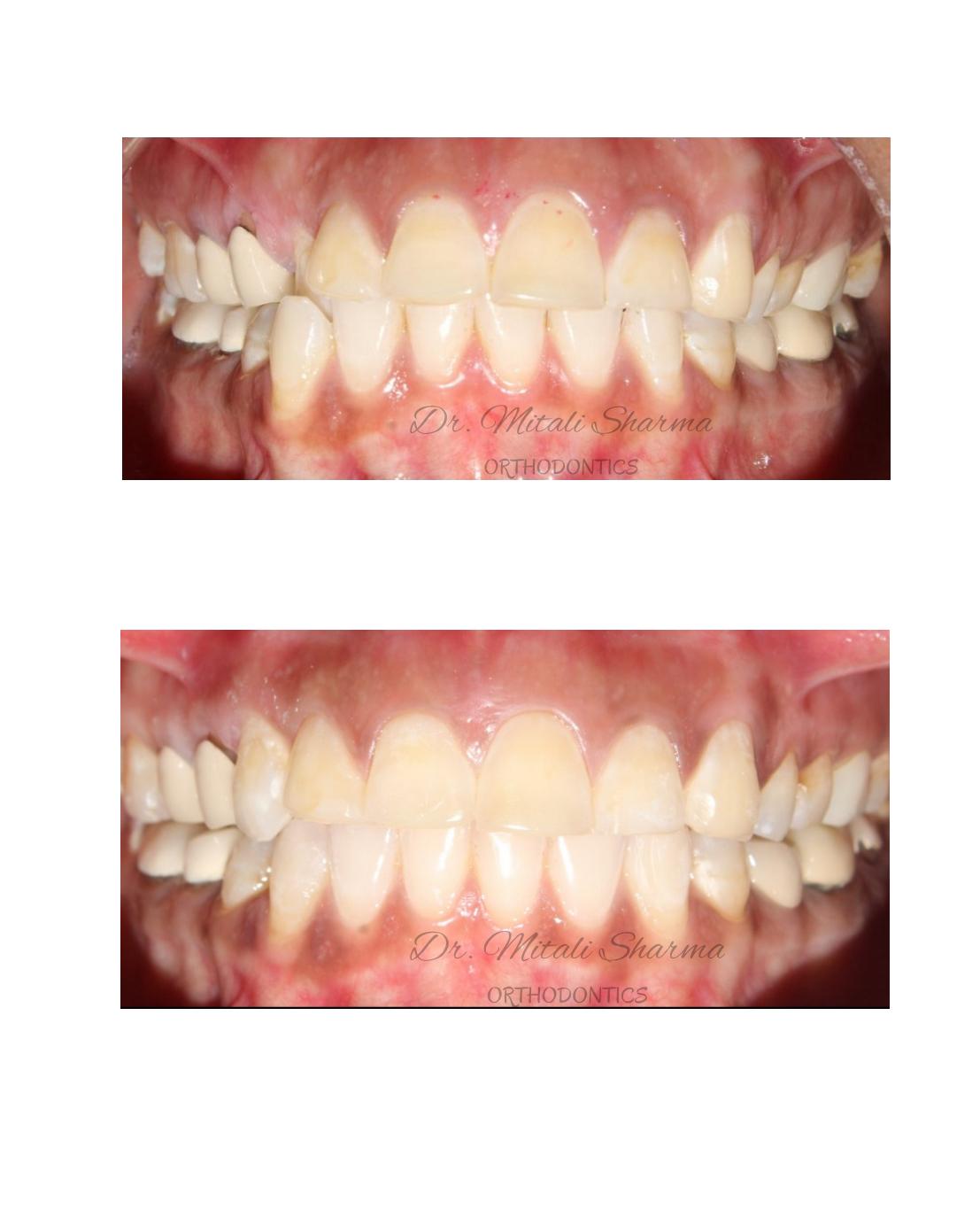 Frontal retracted view before and after Invisalign Lite showing corrected canine crossbite