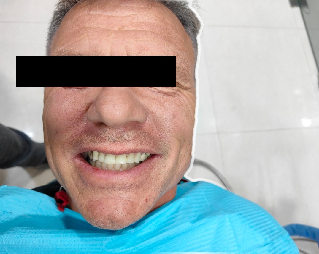 Front view of finished upper-arch rehabilitation — natural white teeth, eyes masked for privacy