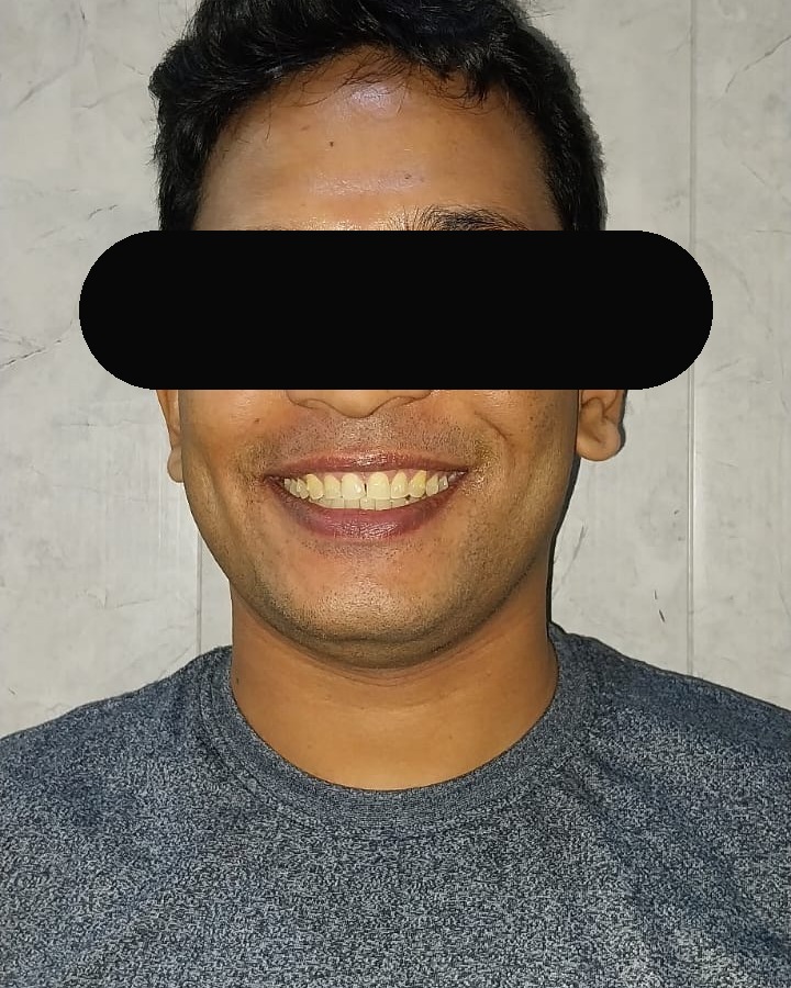 After Invisalign Lite — open confident smile, eyes masked