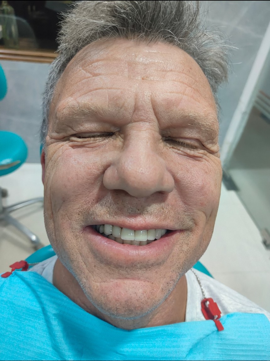 Close-up of the patient laughing with his new upper-arch teeth