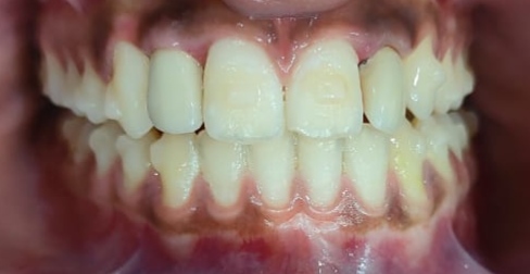 During clear aligner treatment with attachments showing active space creation and bite correction