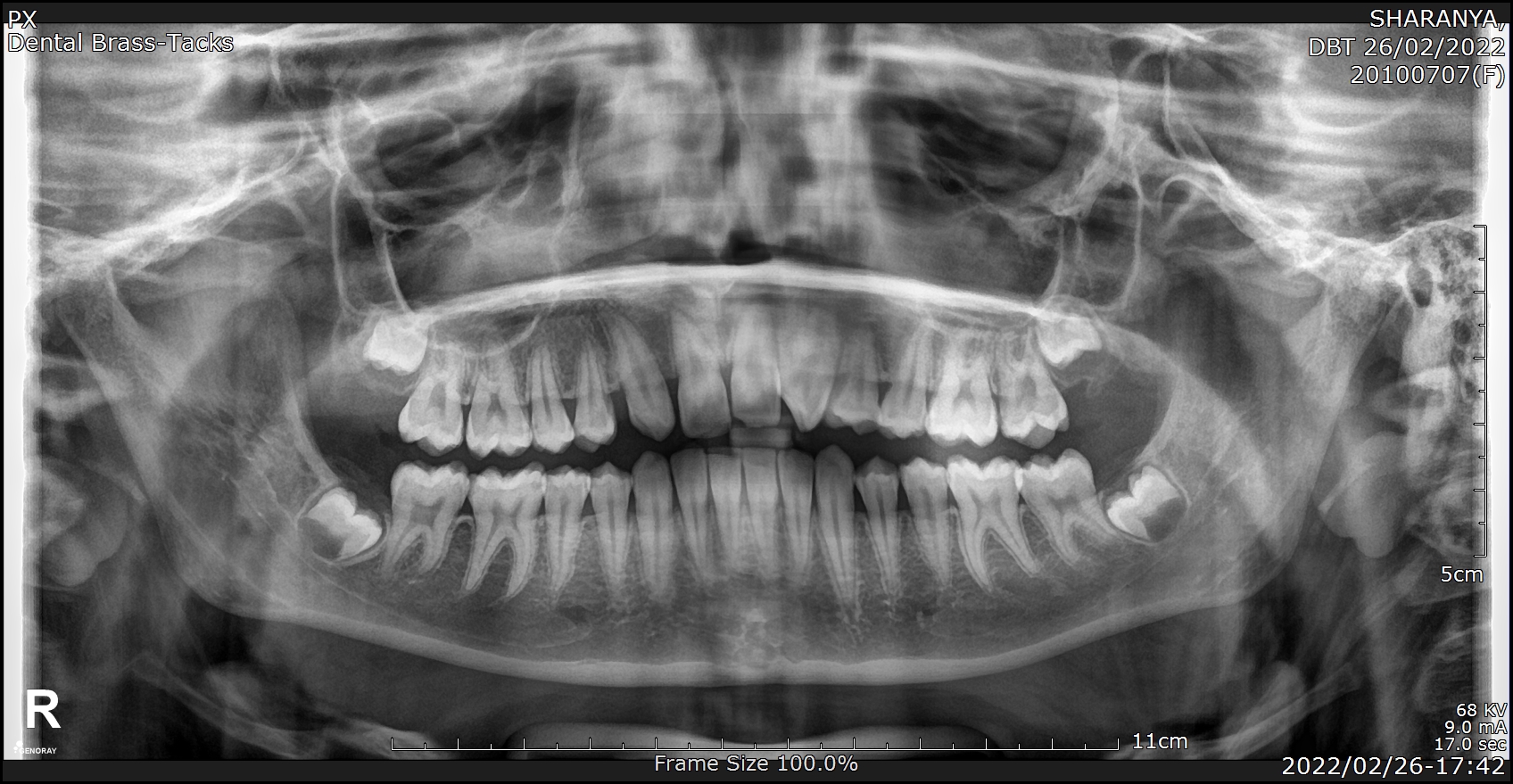Initial panoramic X-ray showing missing upper lateral incisors before orthodontic preparation