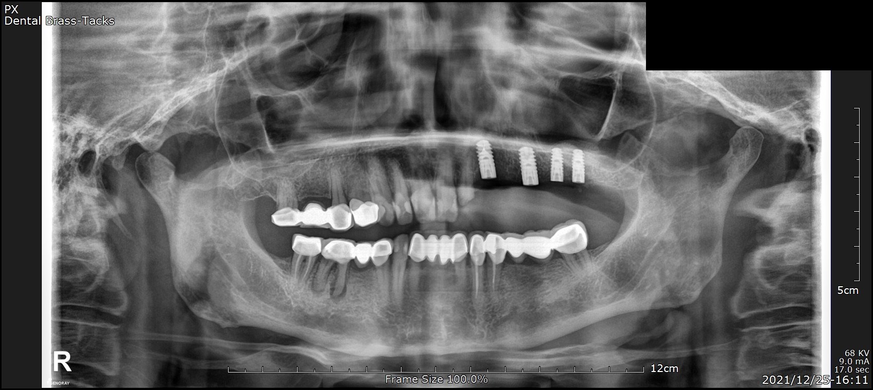 Upper sinus lift + implants — Dec 2021 — panoramic dental X-ray showing implant rehabilitation at Dental Brasstacks, Gurgaon