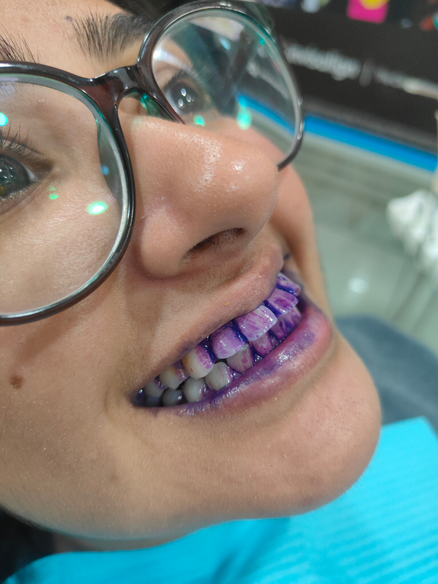 Close-up clinical photograph showing how poorly aligned teeth and bite markings reveal orthodontic issues requiring specialist assessment.