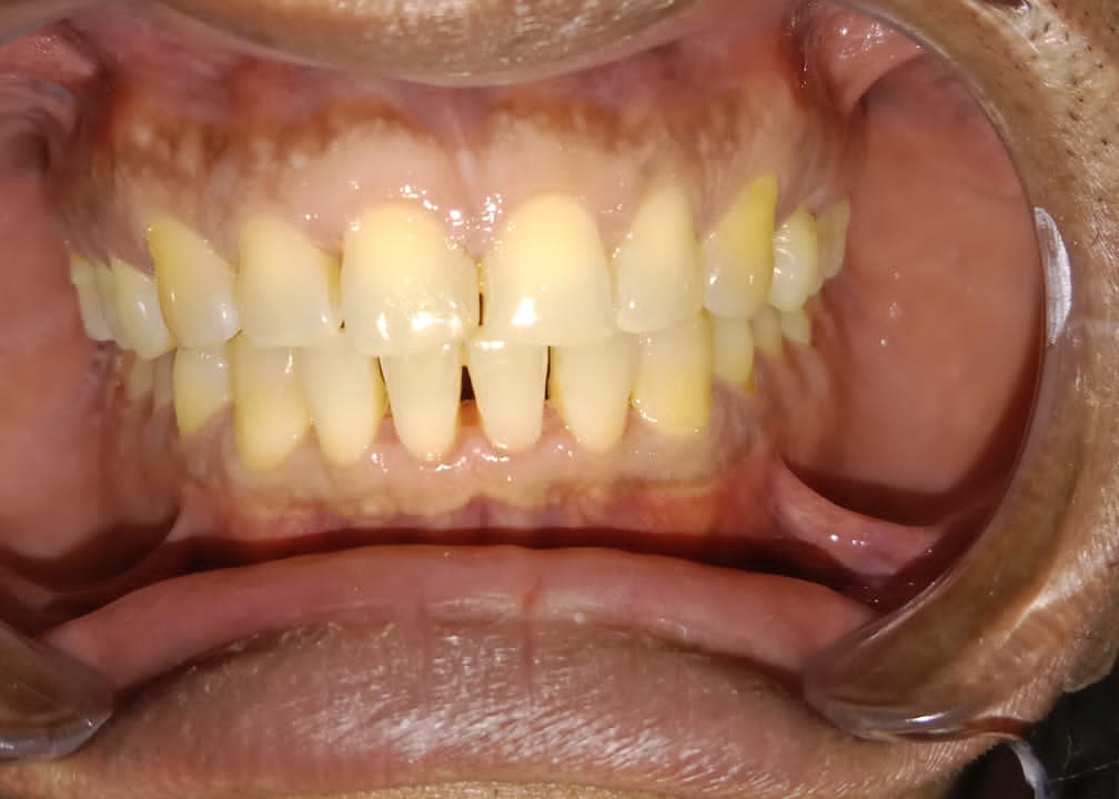 Frontal retracted bite view before Invisalign — crowded anteriors, stair-step relapse, yellowed shade