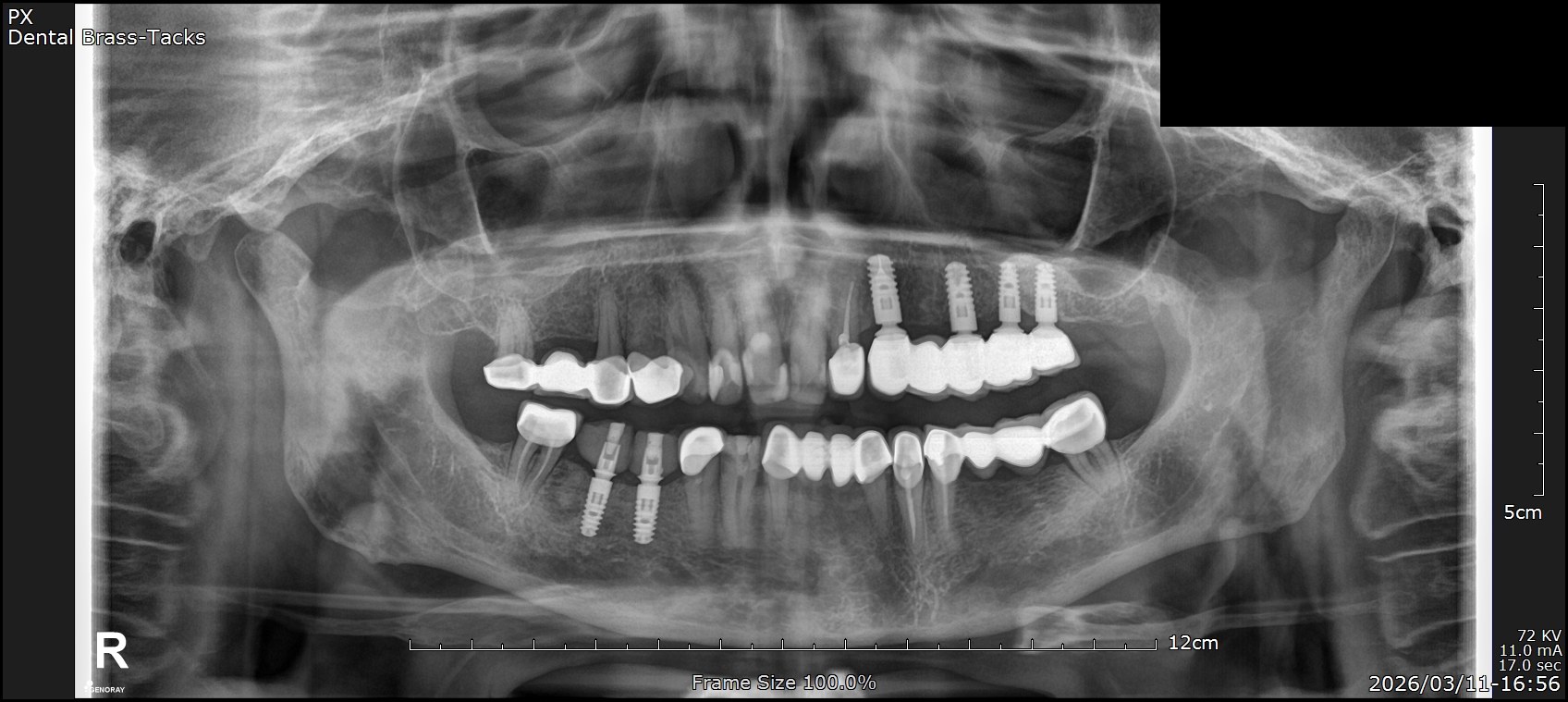Lower rebuild + final restoration — 2026 — panoramic dental X-ray showing implant rehabilitation at Dental Brasstacks, Gurgaon