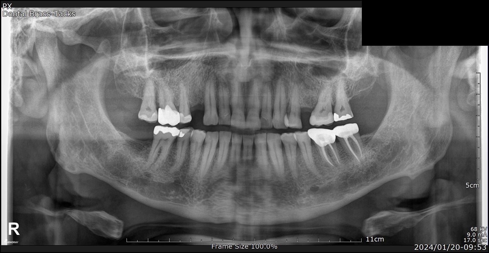 Pre-treatment OPG panoramic X-ray showing missing teeth before Ankylos implant placement