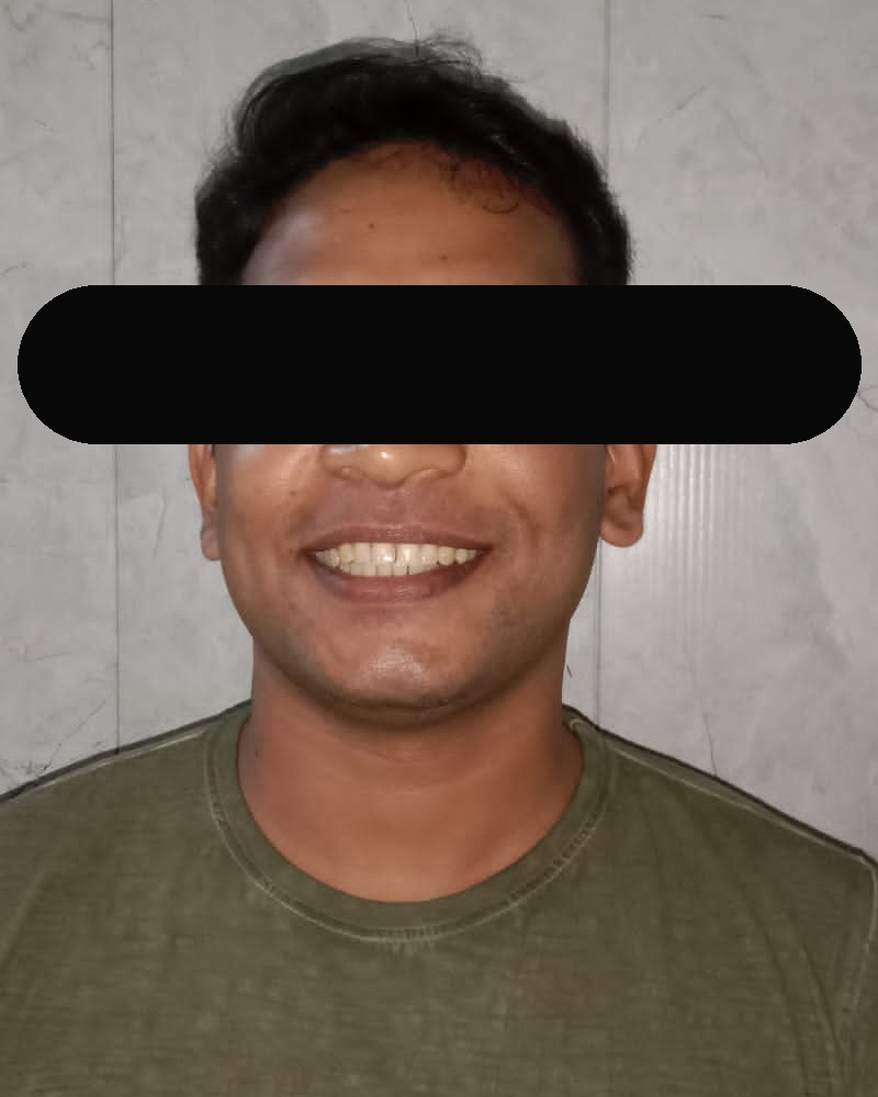 Before Invisalign Lite — relaxed smile portrait, eyes masked