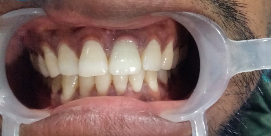 Intraoral close-up showing the final E.max ceramic crown on the upper front tooth implant