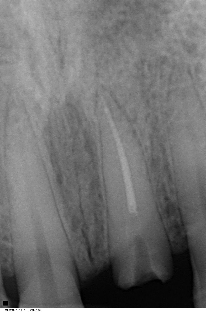 Before — broken RCT tooth — dental X-ray, immediate implant case at Dental Brasstacks, Gurgaon
