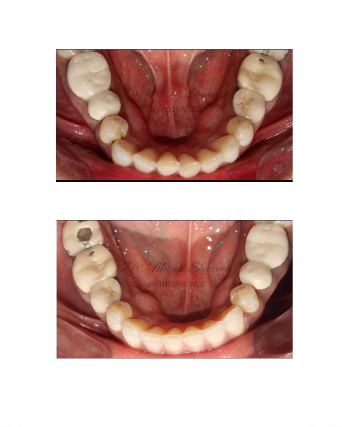 Lower arch occlusal view before and after Invisalign Lite — aligned lower arch