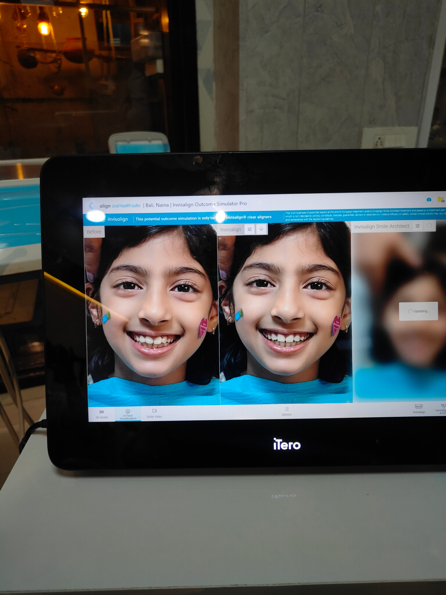 iTero screen showing a before and simulated outcome view of a child's smile