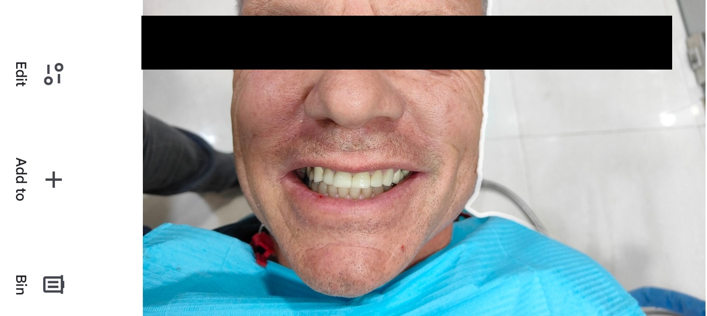 Close-up of finished upper-arch rehabilitation — natural-looking white teeth with no staining