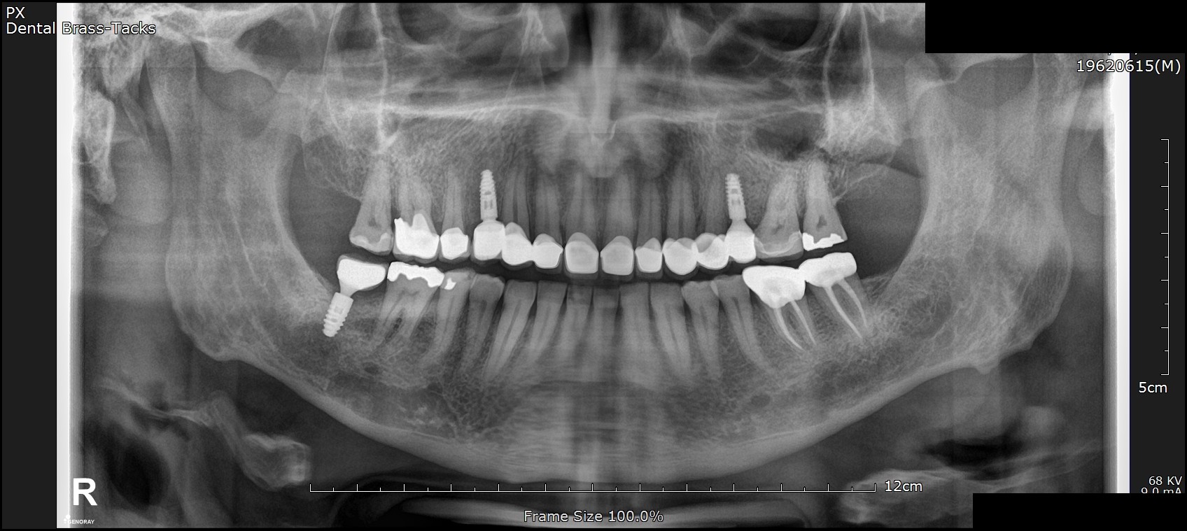 Final OPG panoramic X-ray — Aug 2024 — showing fully restored upper arch over three Ankylos implants