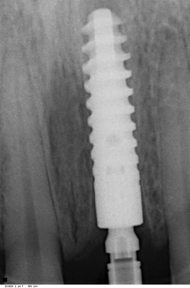 Same day — extraction + immediate implant — dental X-ray, immediate implant case at Dental Brasstacks, Gurgaon