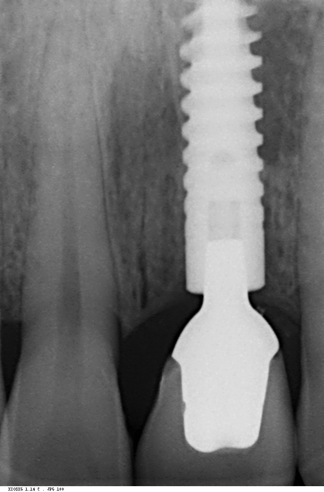 3 months later — zirconia abutment + E.max crown — dental X-ray, immediate implant case at Dental Brasstacks, Gurgaon