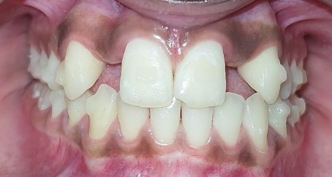 Before orthodontic treatment showing rotated and spaced upper front teeth in a child with missing lateral incisors