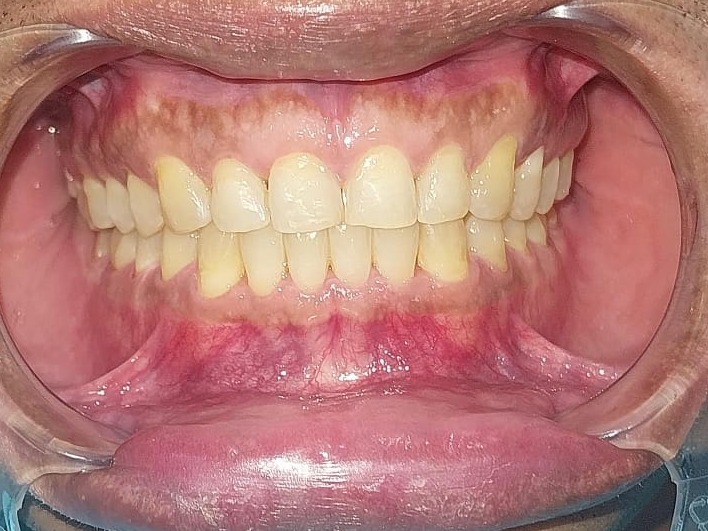 After — frontal retracted view at 12 months, arches level and midlines coincident