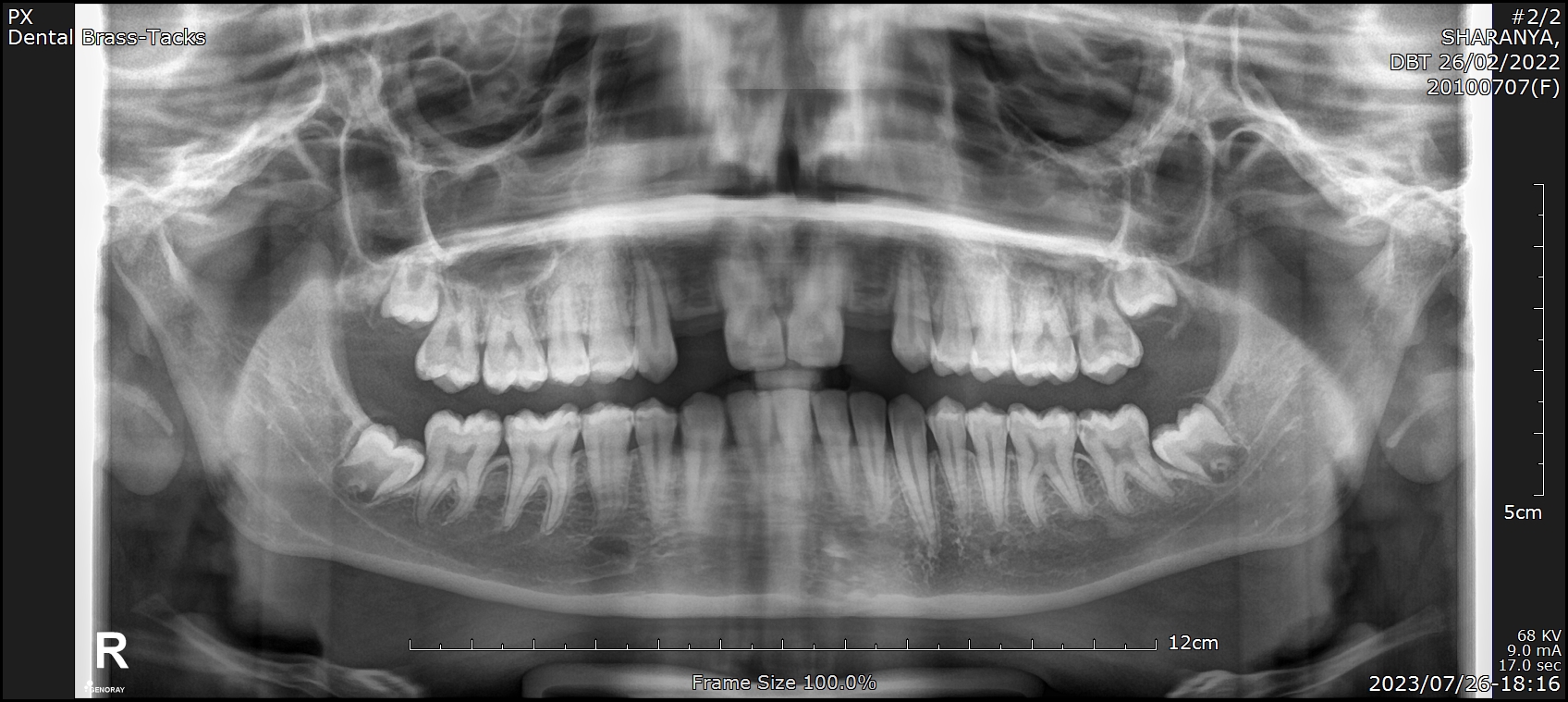 Progress panoramic X-ray showing orthodontic space preparation before implant placement