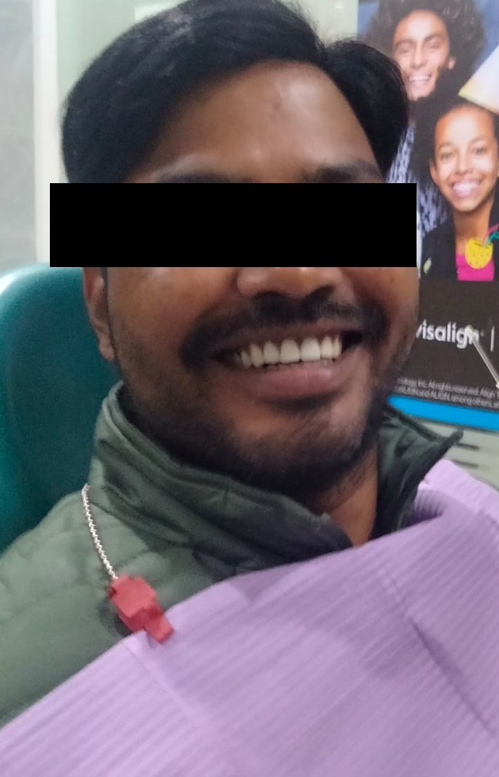 Patient smiling after immediate implant and E.max crown treatment — identity protected
