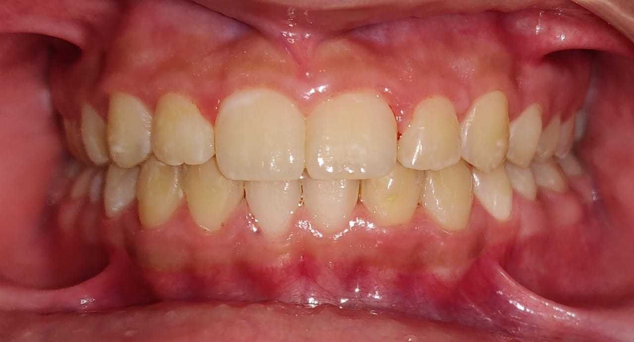 Frontal bite after Invisalign treatment, fully aligned
