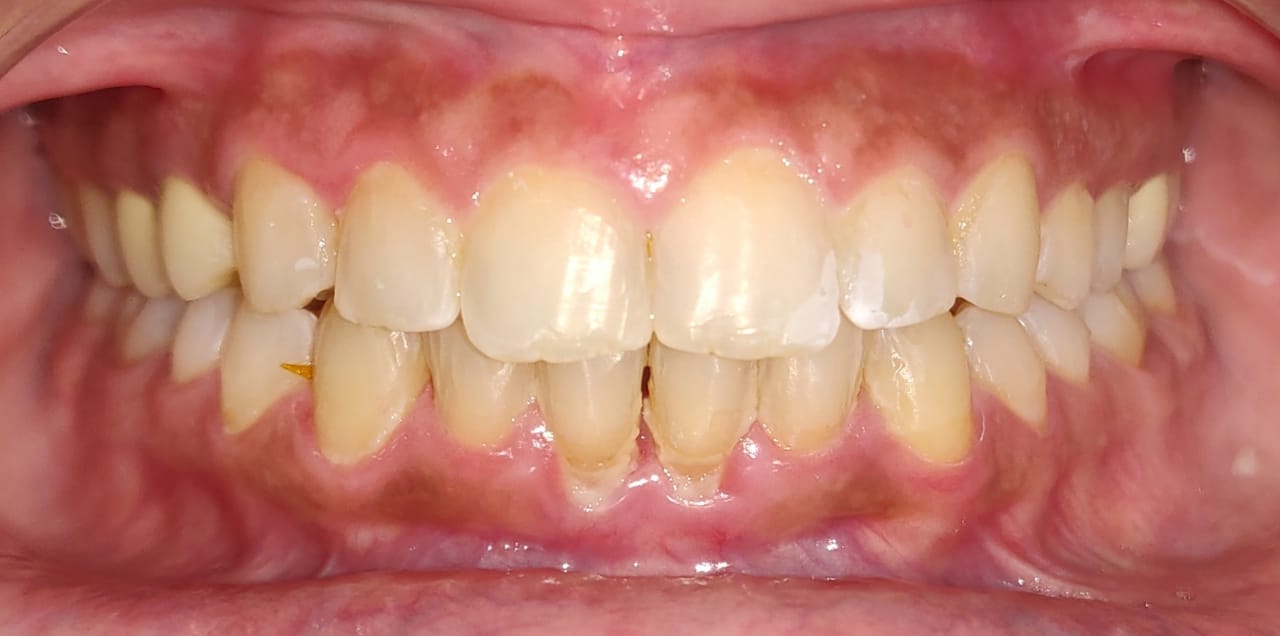 Frontal bite before Invisalign treatment showing crowding