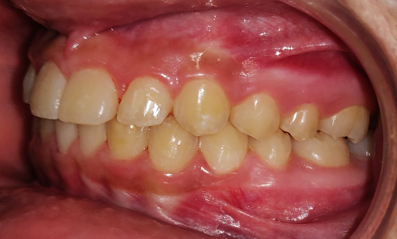Lateral buccal view after treatment with corrected alignment