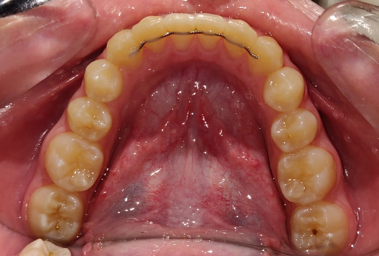 Lower arch occlusal view showing fixed bonded retainer wire