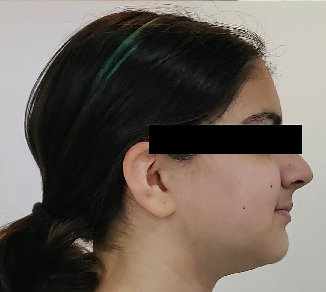 Patient right profile after Invisalign treatment, eyes masked for privacy