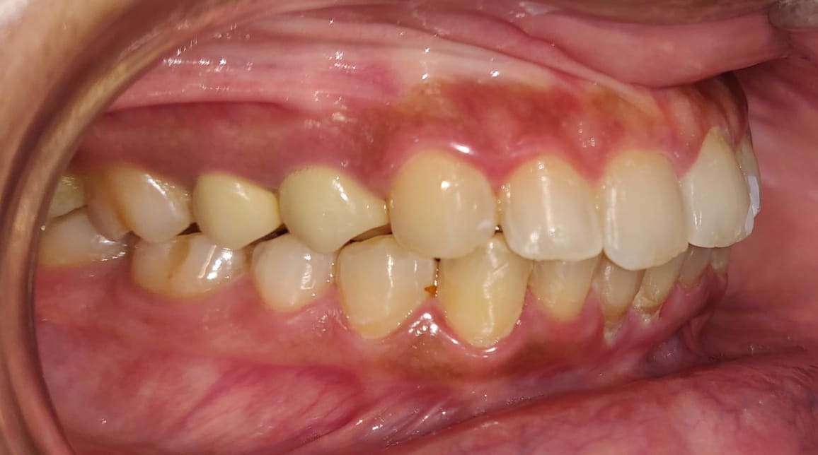 Lateral buccal view before treatment showing irregular alignment