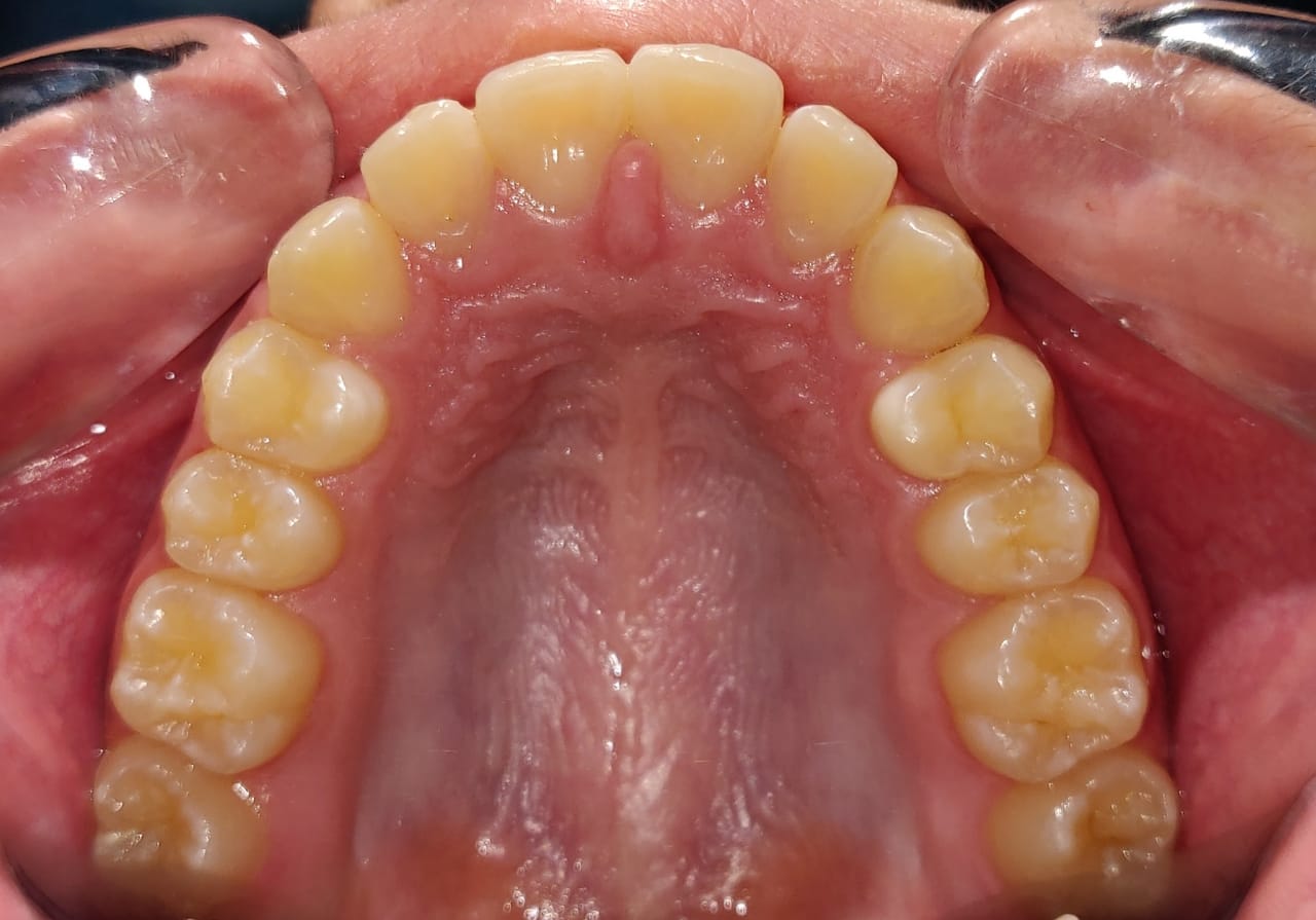 Upper arch development during non-extraction orthodontic treatment in Sector 48 Gurugram