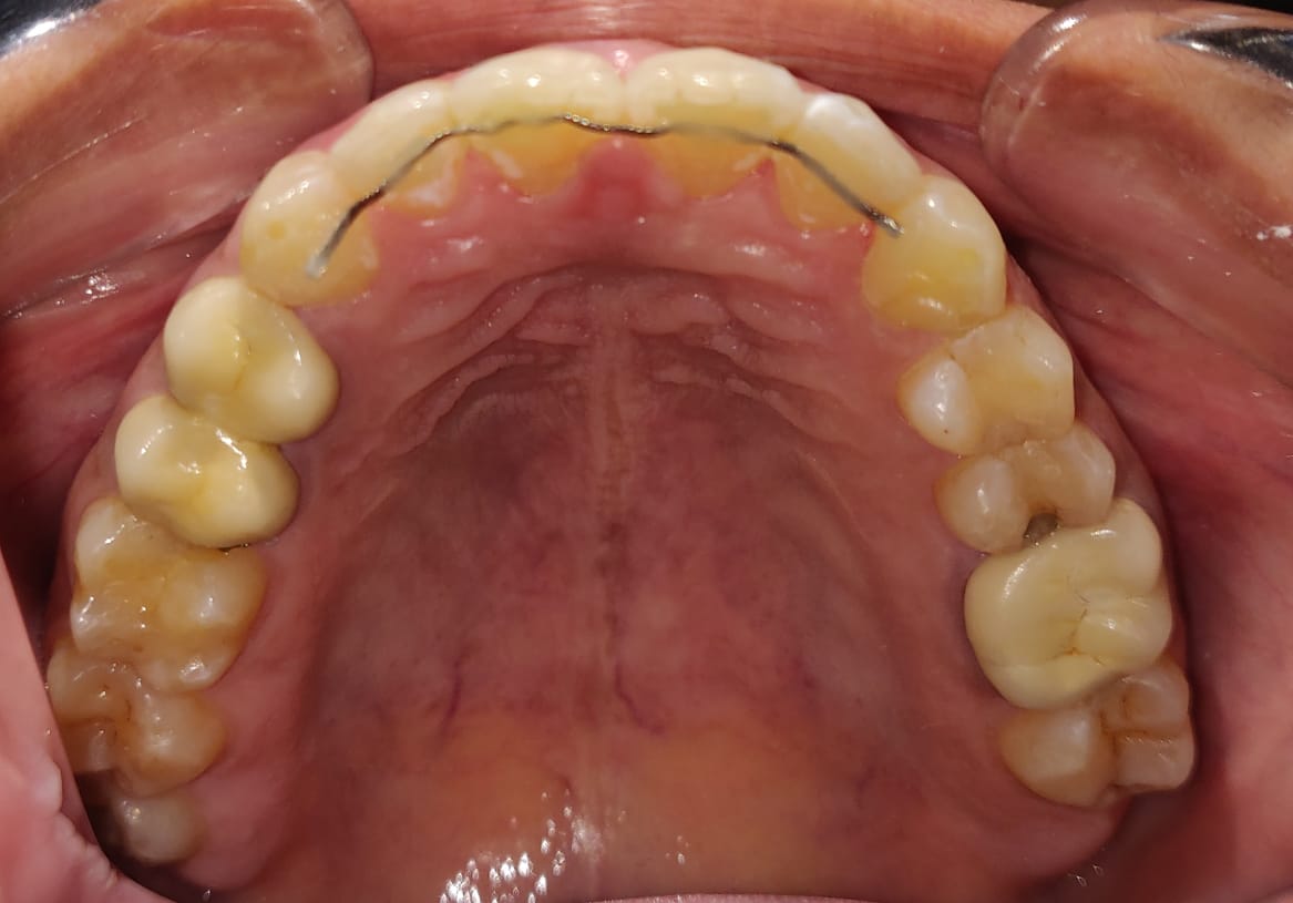 Upper arch occlusal view showing fixed bonded retainer wire