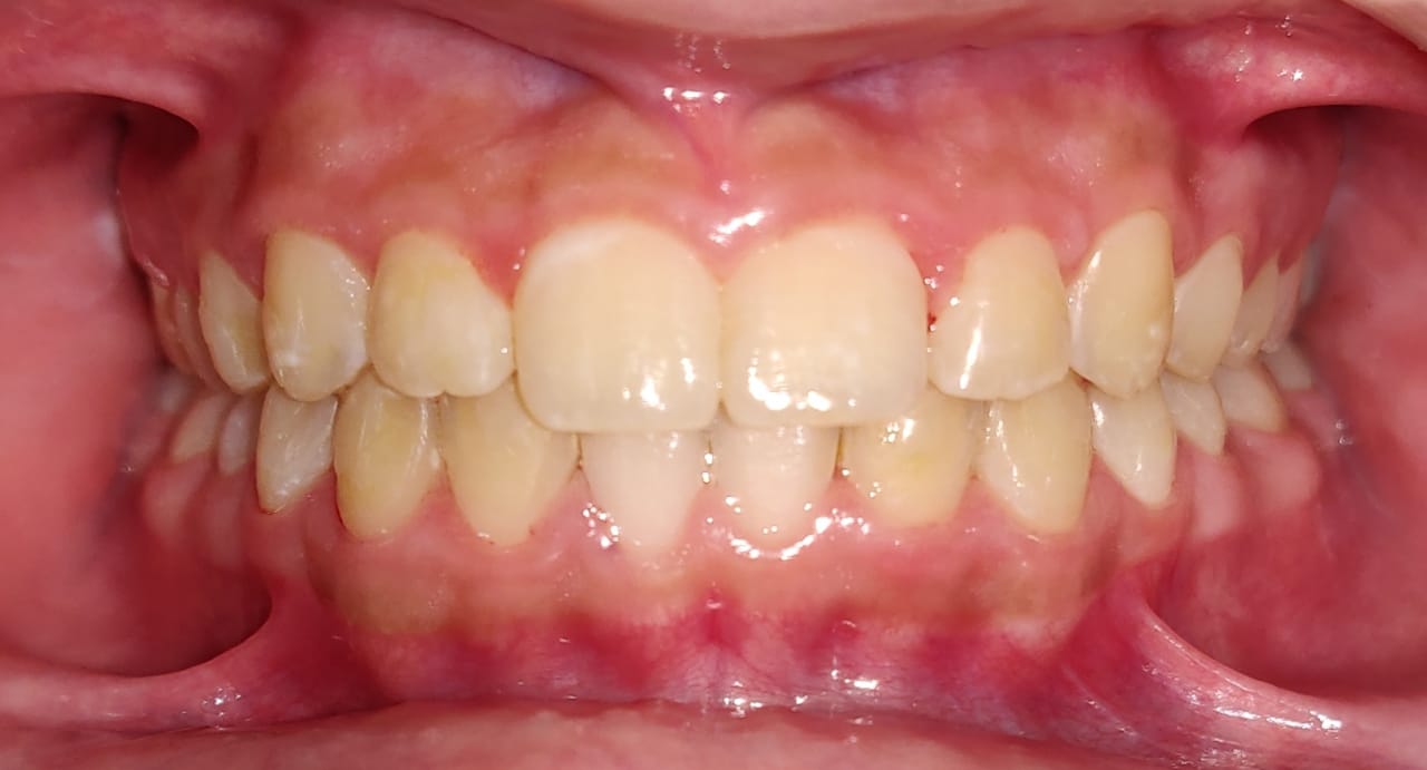 Frontal bite after TMJ-aware orthodontic correction
