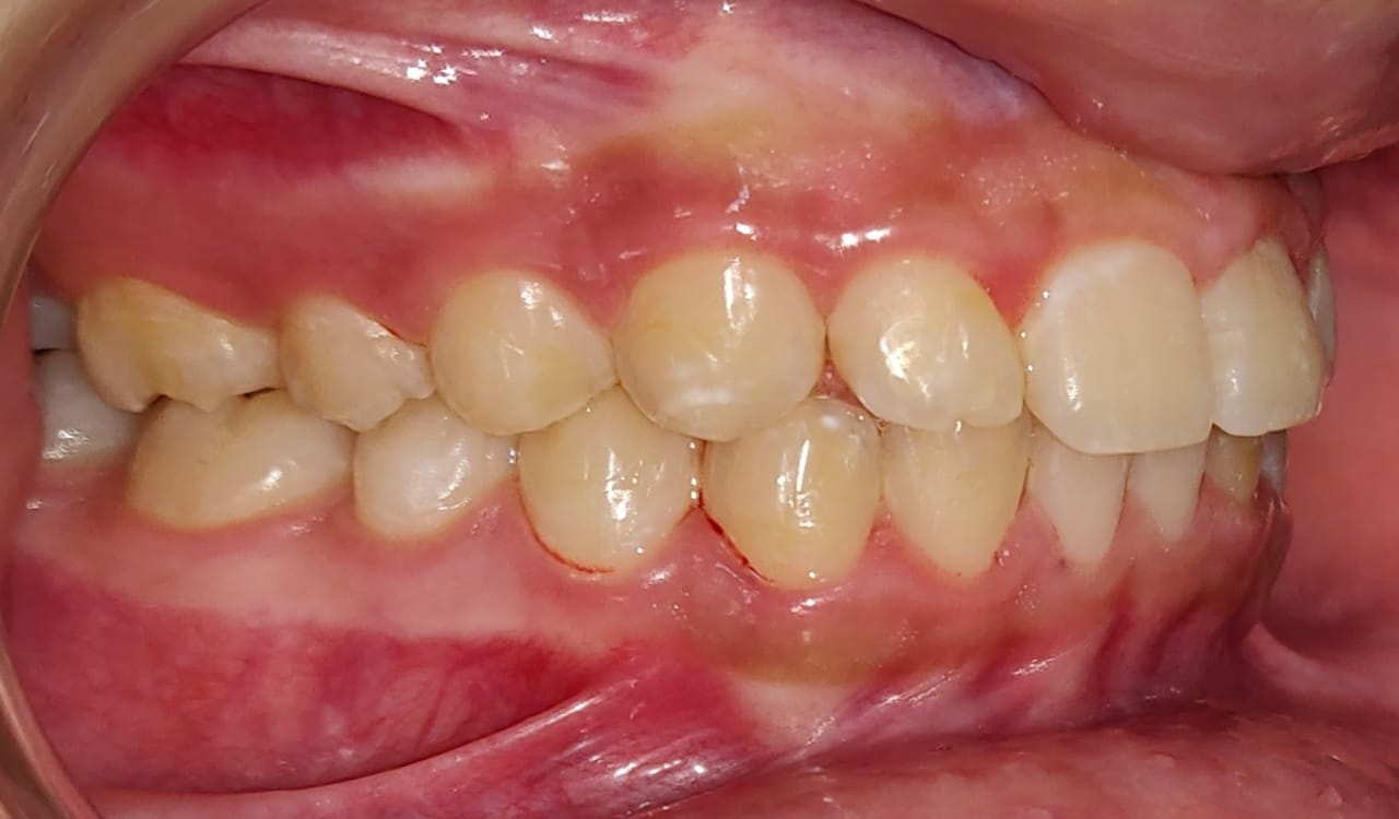 Left buccal view after orthodontic correction