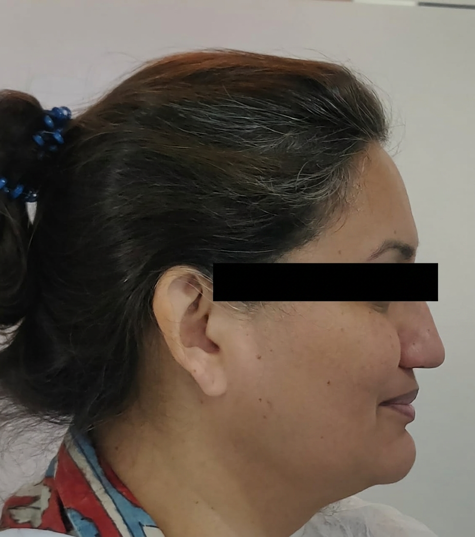 Adult patient right profile after treatment, eyes masked for privacy