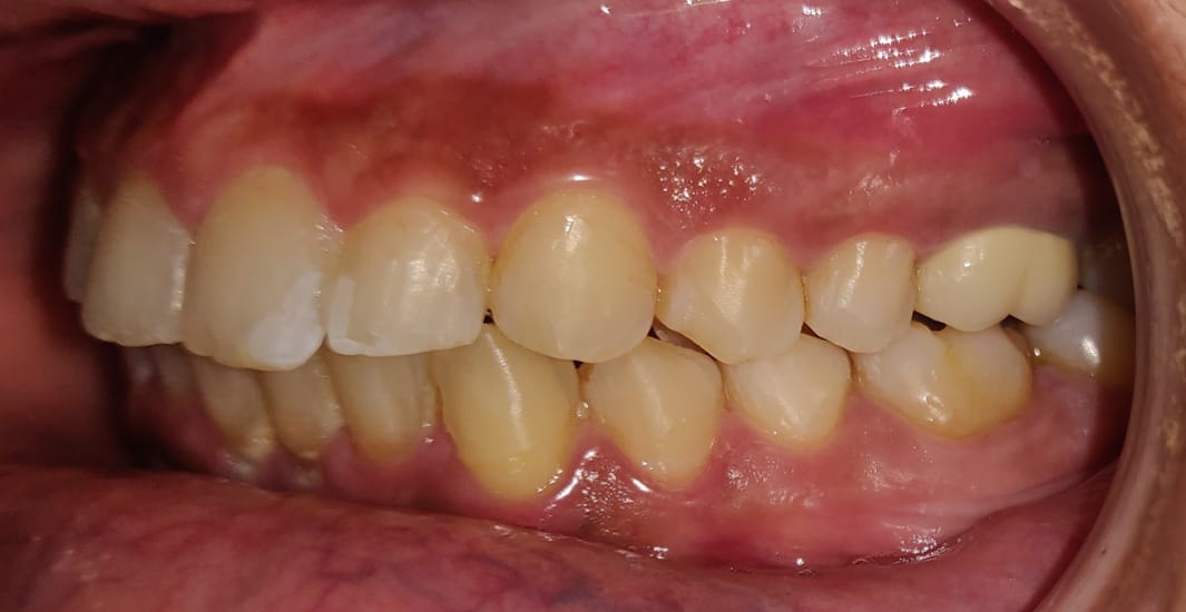Right buccal view after orthodontic correction