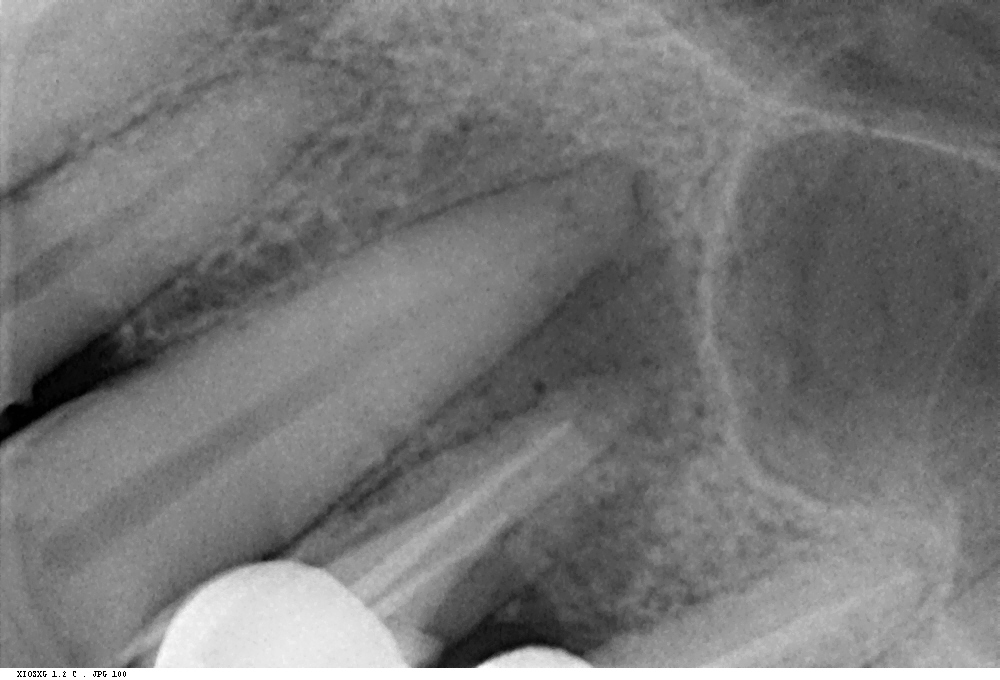 Initial X-ray showing infection around the upper left premolar (old RCT) extending toward the canine — the true source of the abscess.